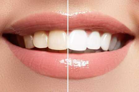 Doç.Dr.İlhan Metin Dağsuyu, diş beyazlatma işlemi yaptırarak beyaz dişlere kavuşmanın üç faydasını paylaştı.